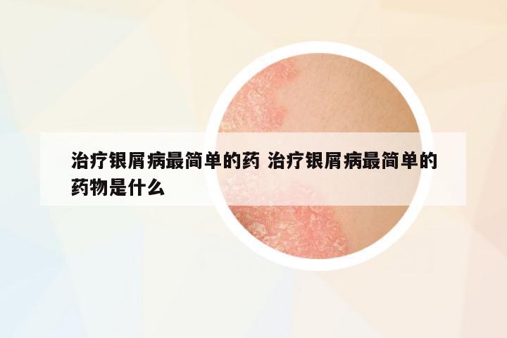 治療銀屑病最簡單的藥 治療銀屑病最簡單的藥物是什么