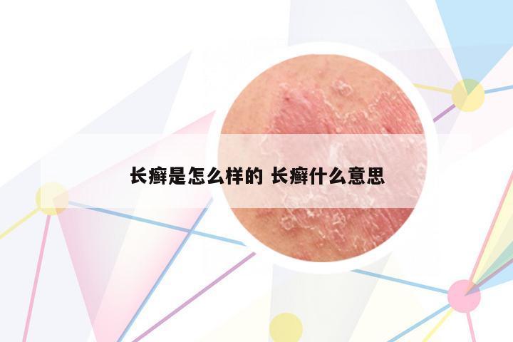 長癬是怎么樣的 長癬什么意思