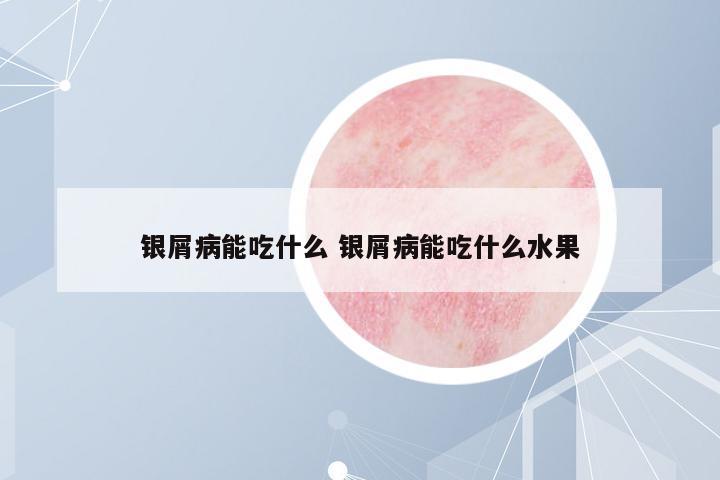 銀屑病能吃什么 銀屑病能吃什么水果