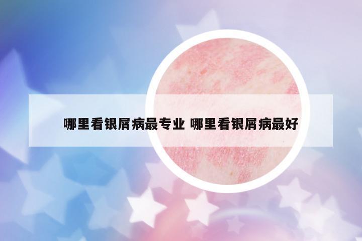 哪里看銀屑病最專業(yè) 哪里看銀屑病最好