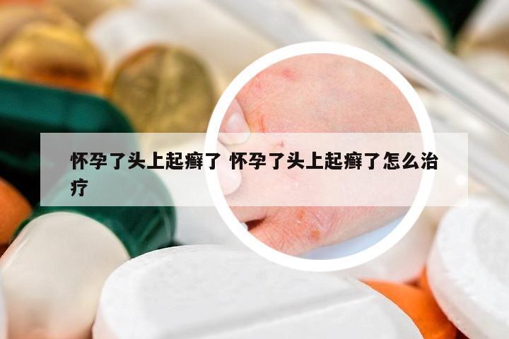 懷孕了頭上起癬了 懷孕了頭上起癬了怎么治療