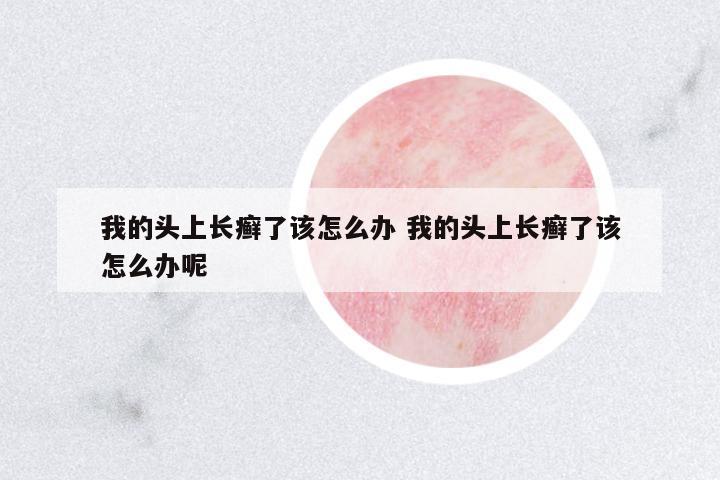 我的頭上長(zhǎng)癬了該怎么辦 我的頭上長(zhǎng)癬了該怎么辦呢
