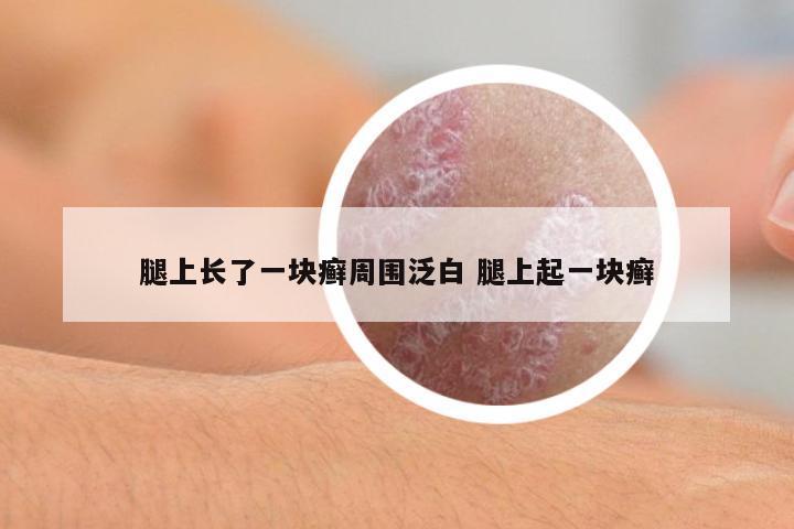 腿上長(zhǎng)了一塊癬周圍泛白 腿上起一塊癬