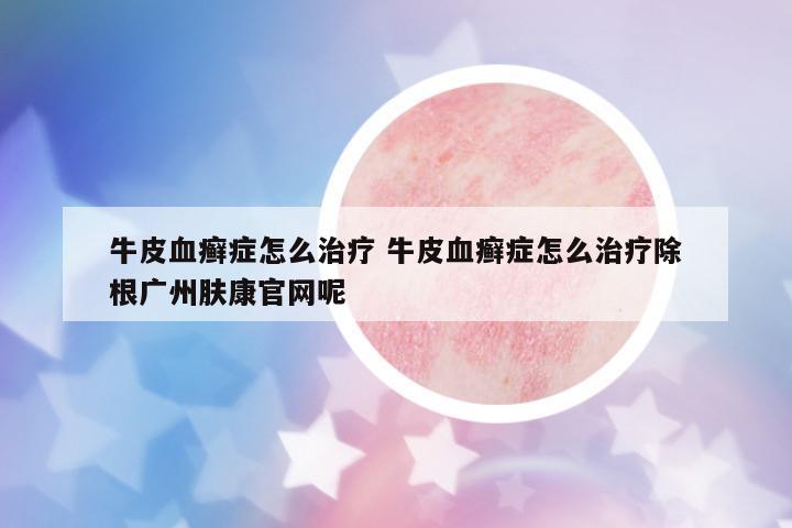 牛皮血癬癥怎么治療 牛皮血癬癥怎么治療除根廣州膚康官網(wǎng)呢