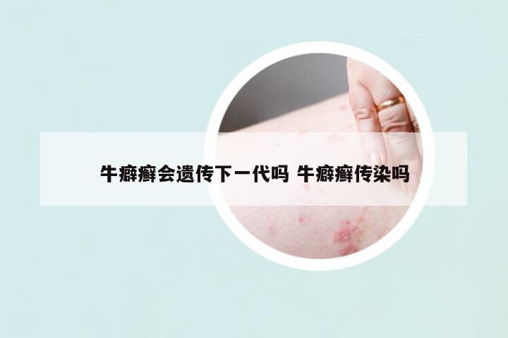 牛癖癬會(huì)遺傳下一代嗎 牛癖癬傳染嗎