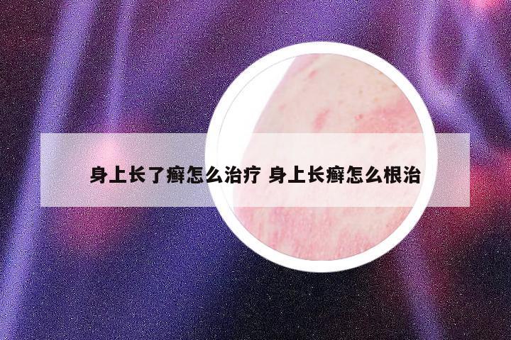 身上長了癬怎么治療 身上長癬怎么根治