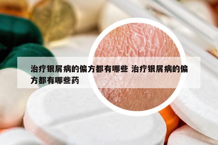 治療銀屑病的偏方都有哪些 治療銀屑病的偏方都有哪些藥