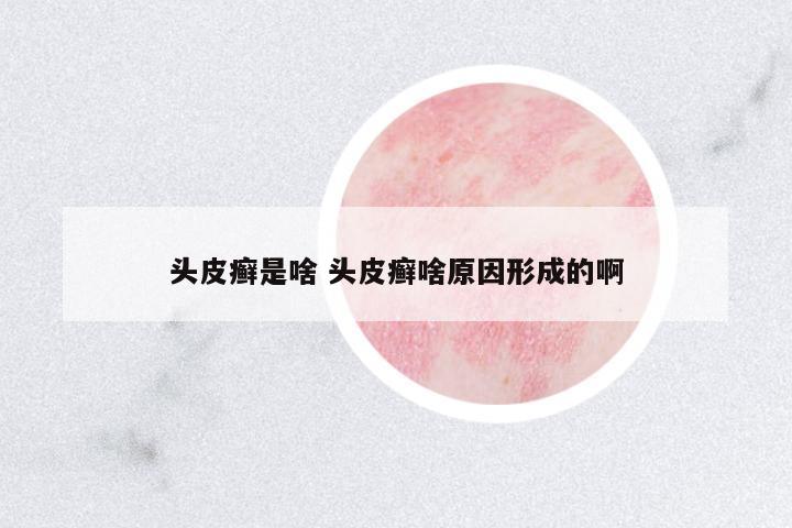 頭皮癬是啥 頭皮癬啥原因形成的啊