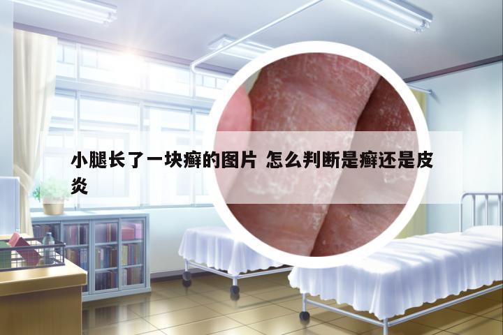 小腿長了一塊癬的圖片 怎么判斷是癬還是皮炎