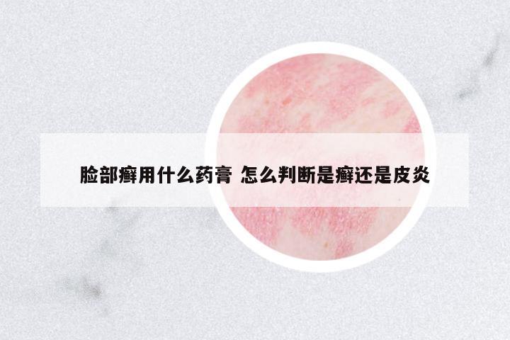 臉部癬用什么藥膏 怎么判斷是癬還是皮炎