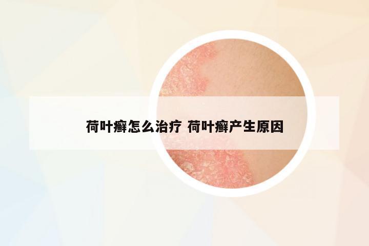 荷葉癬怎么治療 荷葉癬產(chǎn)生原因