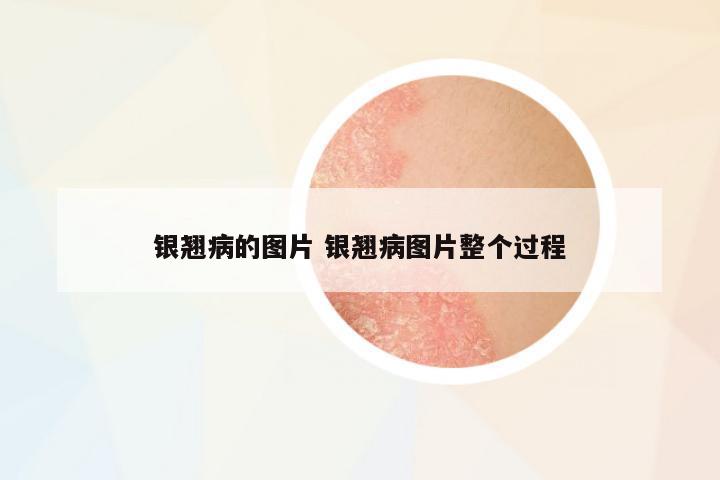 銀翹病的圖片 銀翹病圖片整個(gè)過(guò)程