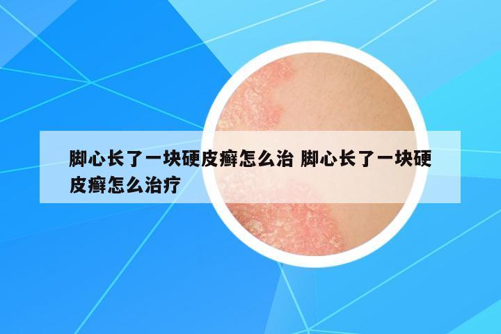 腳心長了一塊硬皮癬怎么治 腳心長了一塊硬皮癬怎么治療
