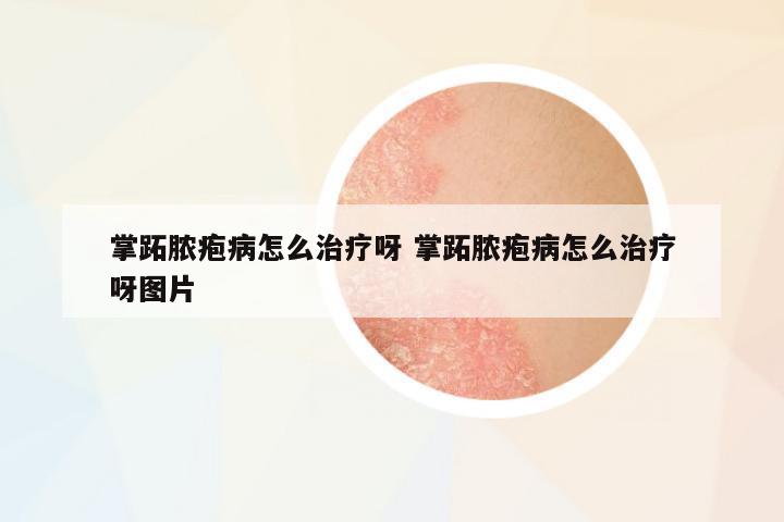 掌跖膿皰病怎么治療呀 掌跖膿皰病怎么治療呀圖片