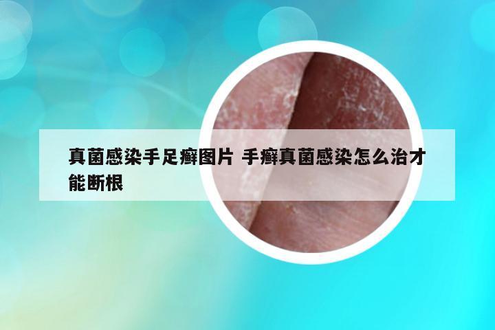 真菌感染手足癬圖片 手癬真菌感染怎么治才能斷根