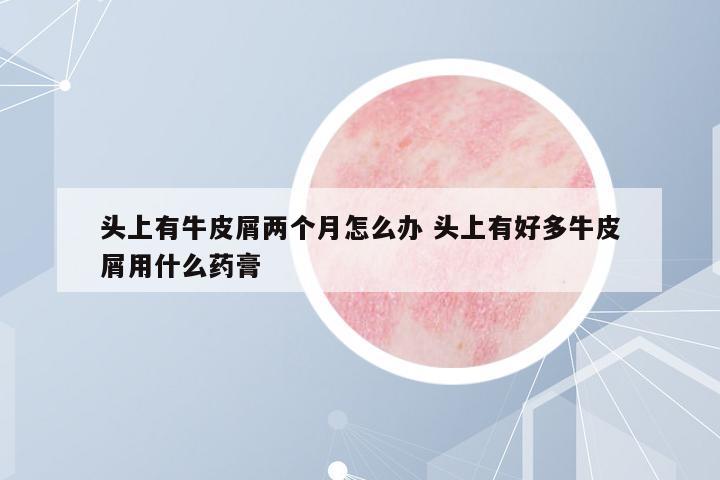 頭上有牛皮屑兩個(gè)月怎么辦 頭上有好多牛皮屑用什么藥膏