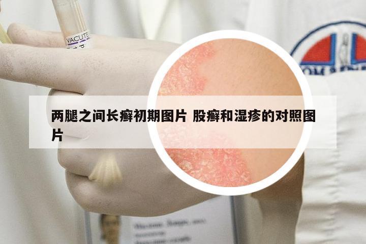 兩腿之間長(zhǎng)癬初期圖片 股癬和濕疹的對(duì)照?qǐng)D片
