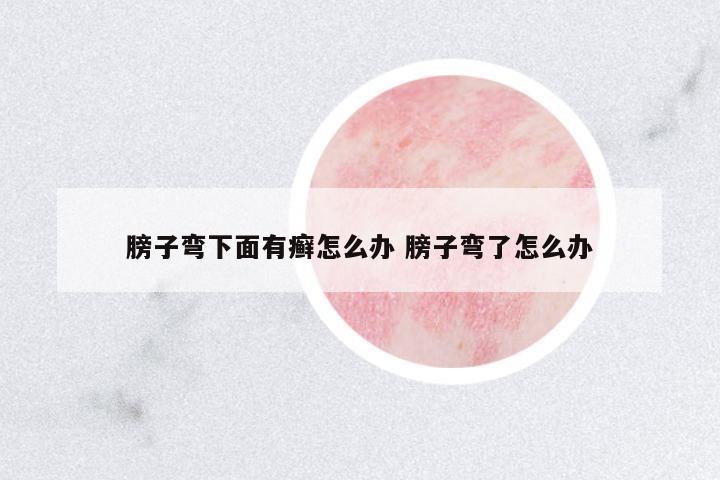 膀子彎下面有癬怎么辦 膀子彎了怎么辦