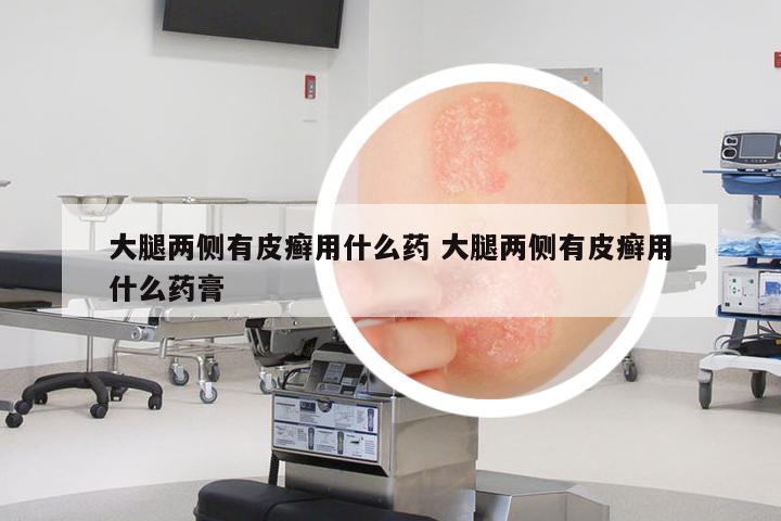 大腿兩側(cè)有皮癬用什么藥 大腿兩側(cè)有皮癬用什么藥膏