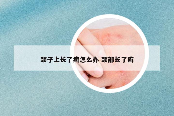頸子上長了癬怎么辦 頸部長了癬