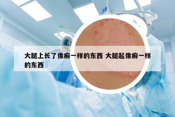 大腿上長(zhǎng)了像癬一樣的東西 大腿起像癬一樣的東西