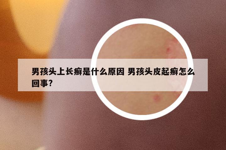 男孩頭上長癬是什么原因 男孩頭皮起癬怎么回事?