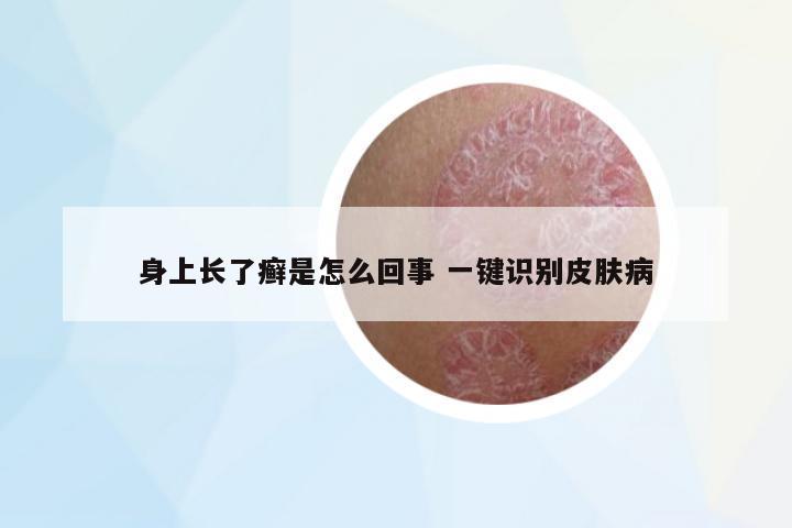 身上長(zhǎng)了癬是怎么回事 一鍵識(shí)別皮膚病