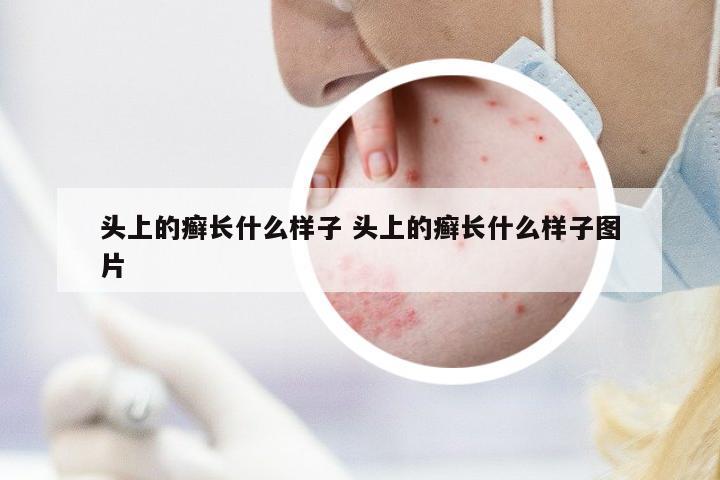 頭上的癬長什么樣子 頭上的癬長什么樣子圖片