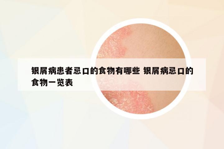 銀屑病患者忌口的食物有哪些 銀屑病忌口的食物一覽表