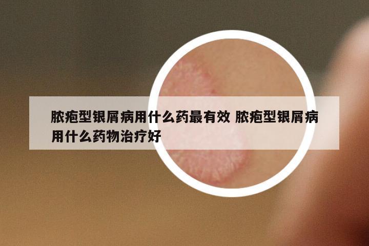 膿皰型銀屑病用什么藥最有效 膿皰型銀屑病用什么藥物治療好
