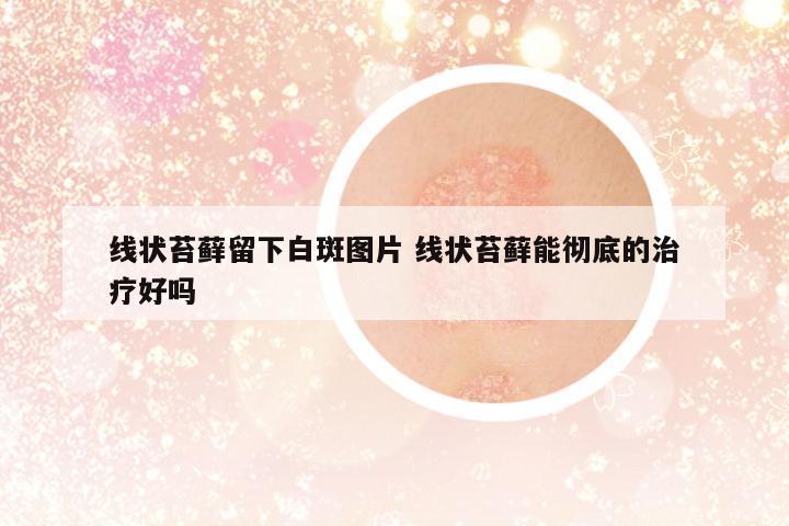 線狀苔蘚留下白斑圖片 線狀苔蘚能徹底的治療好嗎