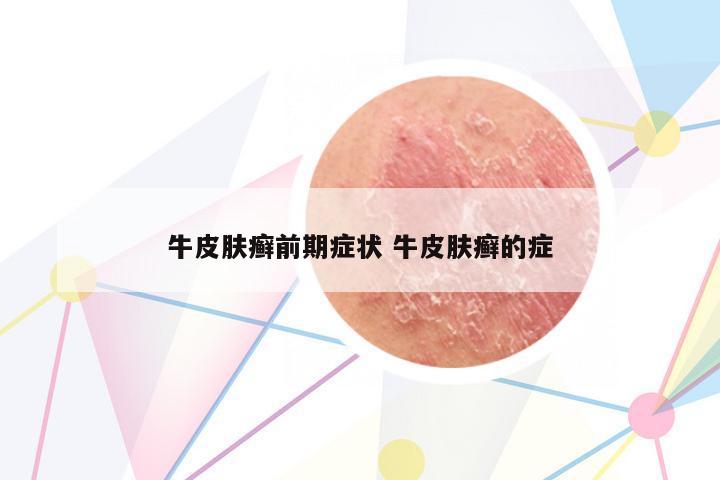 牛皮膚癬前期癥狀 牛皮膚癬的癥