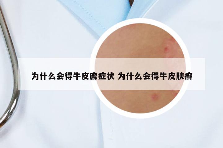 為什么會得牛皮廨癥狀 為什么會得牛皮膚癬