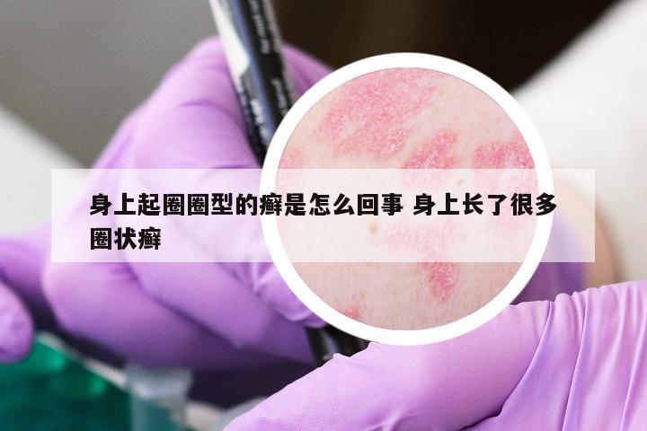 身上起圈圈型的癬是怎么回事 身上長(zhǎng)了很多圈狀癬