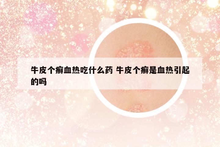 牛皮個(gè)癬血熱吃什么藥 牛皮個(gè)癬是血熱引起的嗎