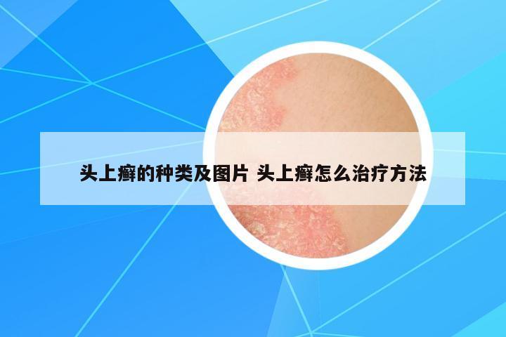 頭上癬的種類及圖片 頭上癬怎么治療方法