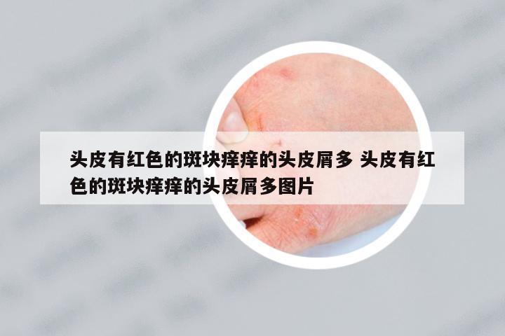 頭皮有紅色的斑塊癢癢的頭皮屑多 頭皮有紅色的斑塊癢癢的頭皮屑多圖片