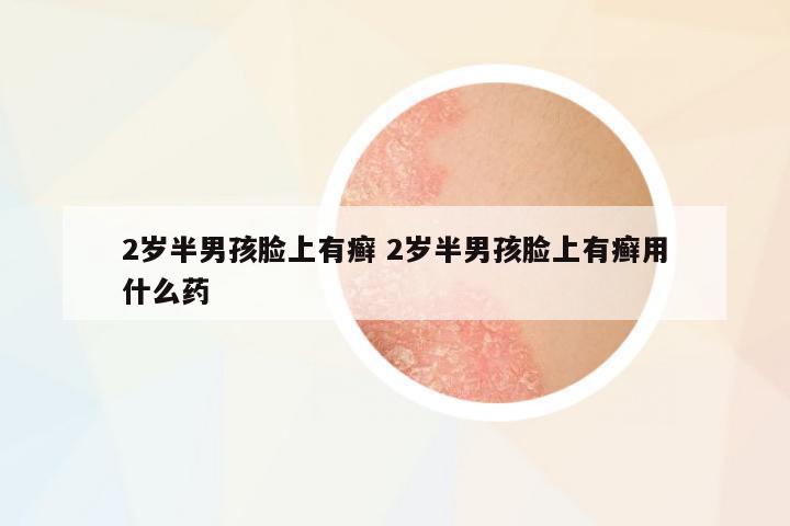 2歲半男孩臉上有癬 2歲半男孩臉上有癬用什么藥