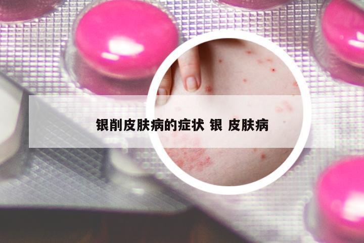 銀削皮膚病的癥狀 銀 皮膚病