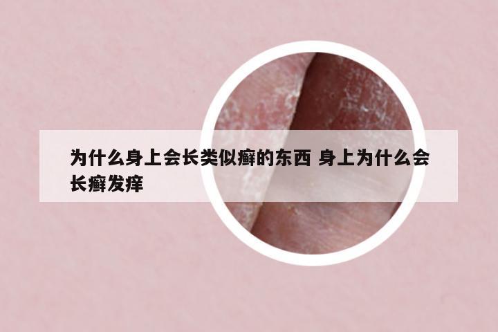 為什么身上會(huì)長(zhǎng)類似癬的東西 身上為什么會(huì)長(zhǎng)癬發(fā)癢