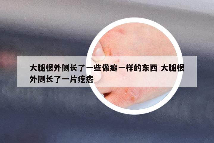 大腿根外側(cè)長了一些像癬一樣的東西 大腿根外側(cè)長了一片疙瘩