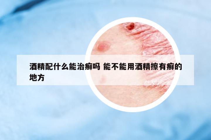 酒精配什么能治癬嗎 能不能用酒精擦有癬的地方