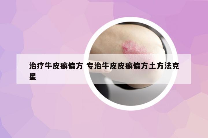 治療牛皮癬偏方 專治牛皮皮癬偏方土方法克星