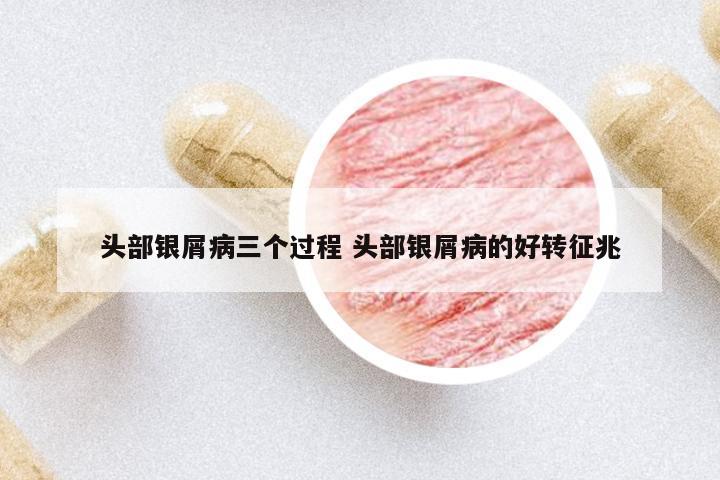 頭部銀屑病三個(gè)過(guò)程 頭部銀屑病的好轉(zhuǎn)征兆