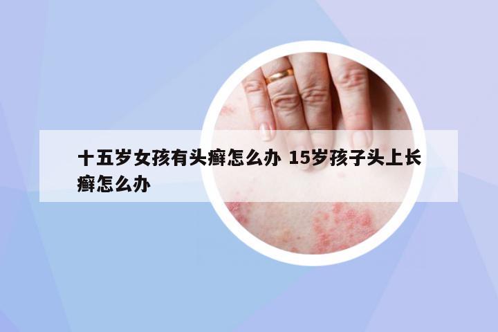 十五歲女孩有頭癬怎么辦 15歲孩子頭上長癬怎么辦