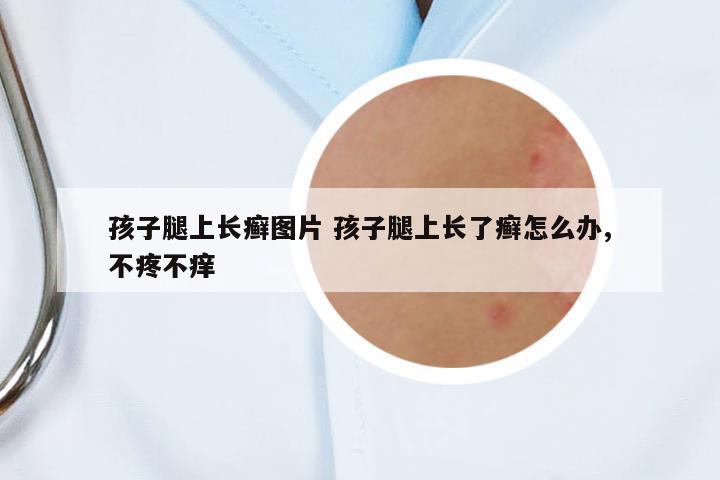 孩子腿上長癬圖片 孩子腿上長了癬怎么辦,不疼不癢