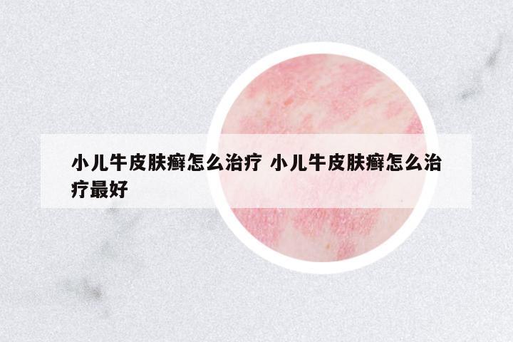 小兒牛皮膚癬怎么治療 小兒牛皮膚癬怎么治療最好