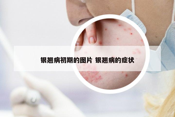 銀翹病初期的圖片 銀翹病的癥狀