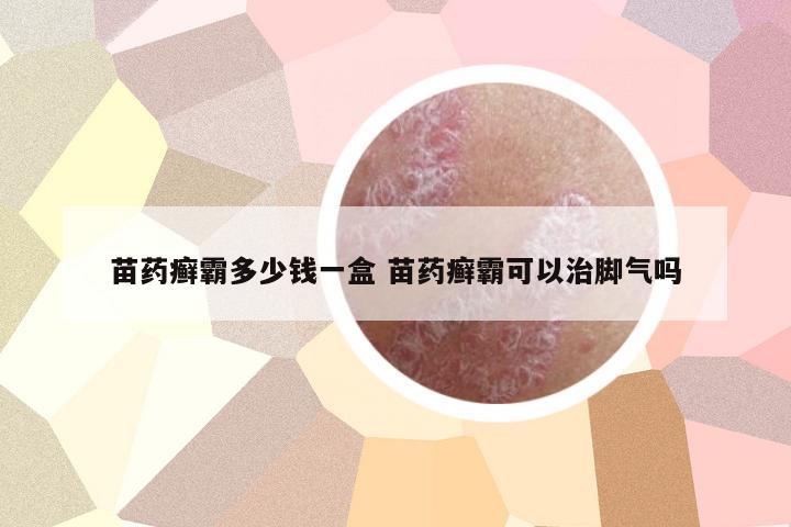 苗藥癬霸多少錢一盒 苗藥癬霸可以治腳氣嗎