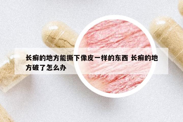 長癬的地方能撕下像皮一樣的東西 長癬的地方破了怎么辦